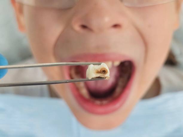 Best Emergency Root Canal Treatment in Antioch, IL