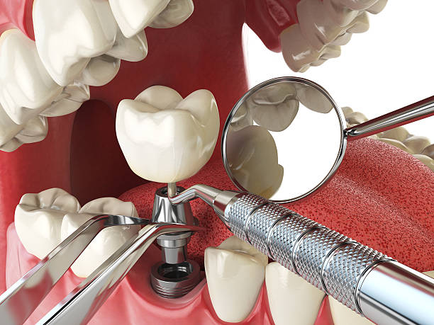 Best Emergency Tooth Extraction in Antioch, IL